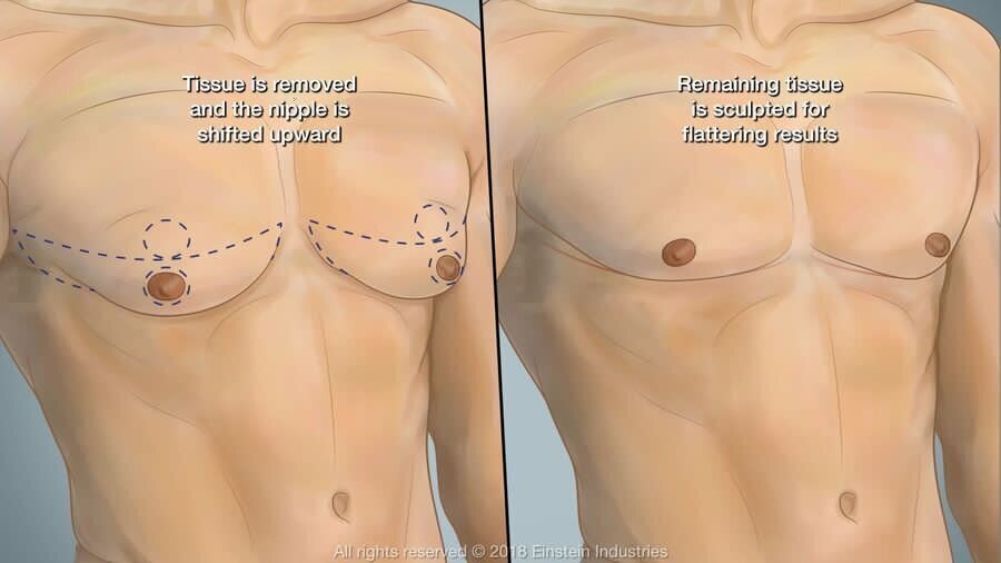 Breast Lift for Men (Nipple Position) - iMed Medical
