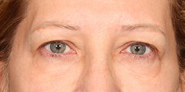 Blepharoplasty Before & After Image