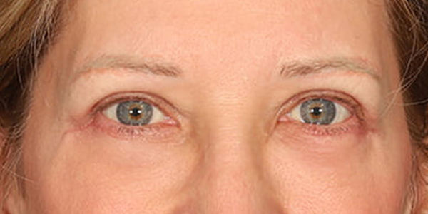 Blepharoplasty Before & After Image