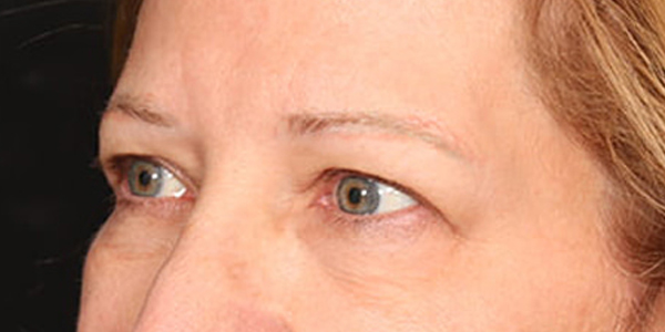 Blepharoplasty Before & After Image