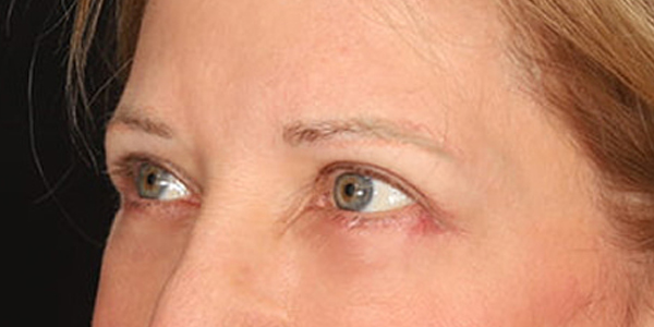 Blepharoplasty Before & After Image