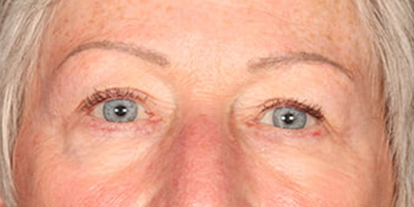 Blepharoplasty Before & After Image