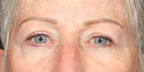 Blepharoplasty Before & After Image