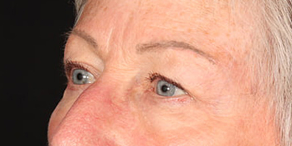 Blepharoplasty Before & After Image