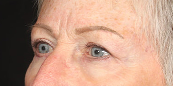 Blepharoplasty Before & After Image