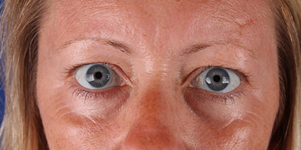 Blepharoplasty Before & After Image