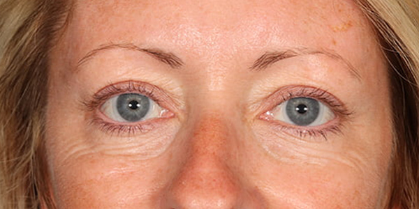 Blepharoplasty Before & After Image