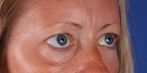 Blepharoplasty Before & After Image