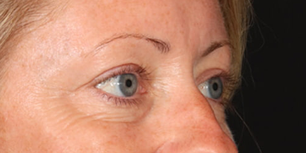 Blepharoplasty Before & After Image