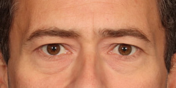 Blepharoplasty Before & After Image