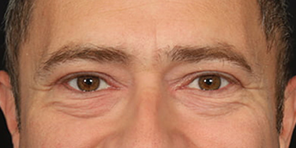 Blepharoplasty Before & After Image