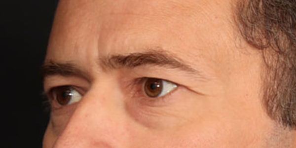 Blepharoplasty Before & After Image