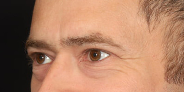 Blepharoplasty Before & After Image